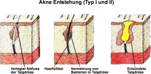 Akne Behandlung Dermatherm